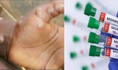 उत्तराखंड में मंकीपॉक्स की दस्तक! प्रशासन और स्वास्थ्य विभाग अलर्ट