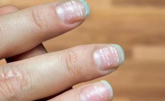 बदलते नाखून शरीर में इस समस्या का संकेत देते हैं